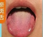 瘀斑舌