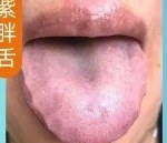 紫胖舌