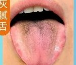 灰腻苔舌
