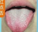 红点舌