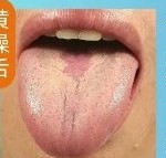 黄燥舌