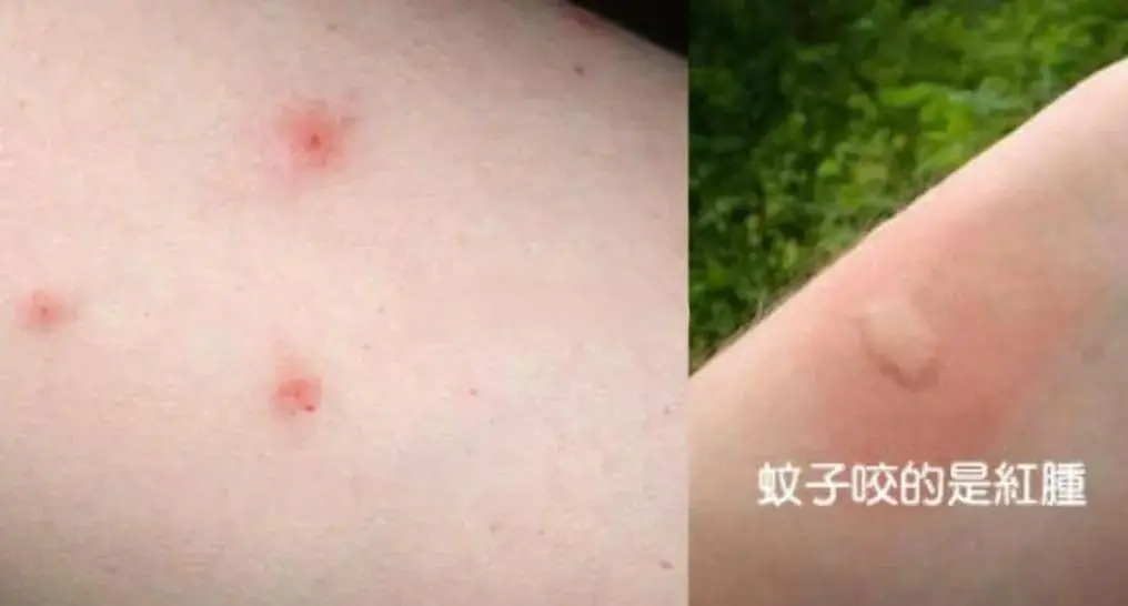 丘疹性荨麻疹临床图谱