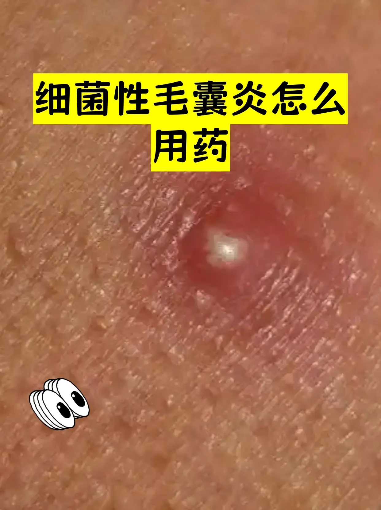 细菌性毛囊炎临床图谱
