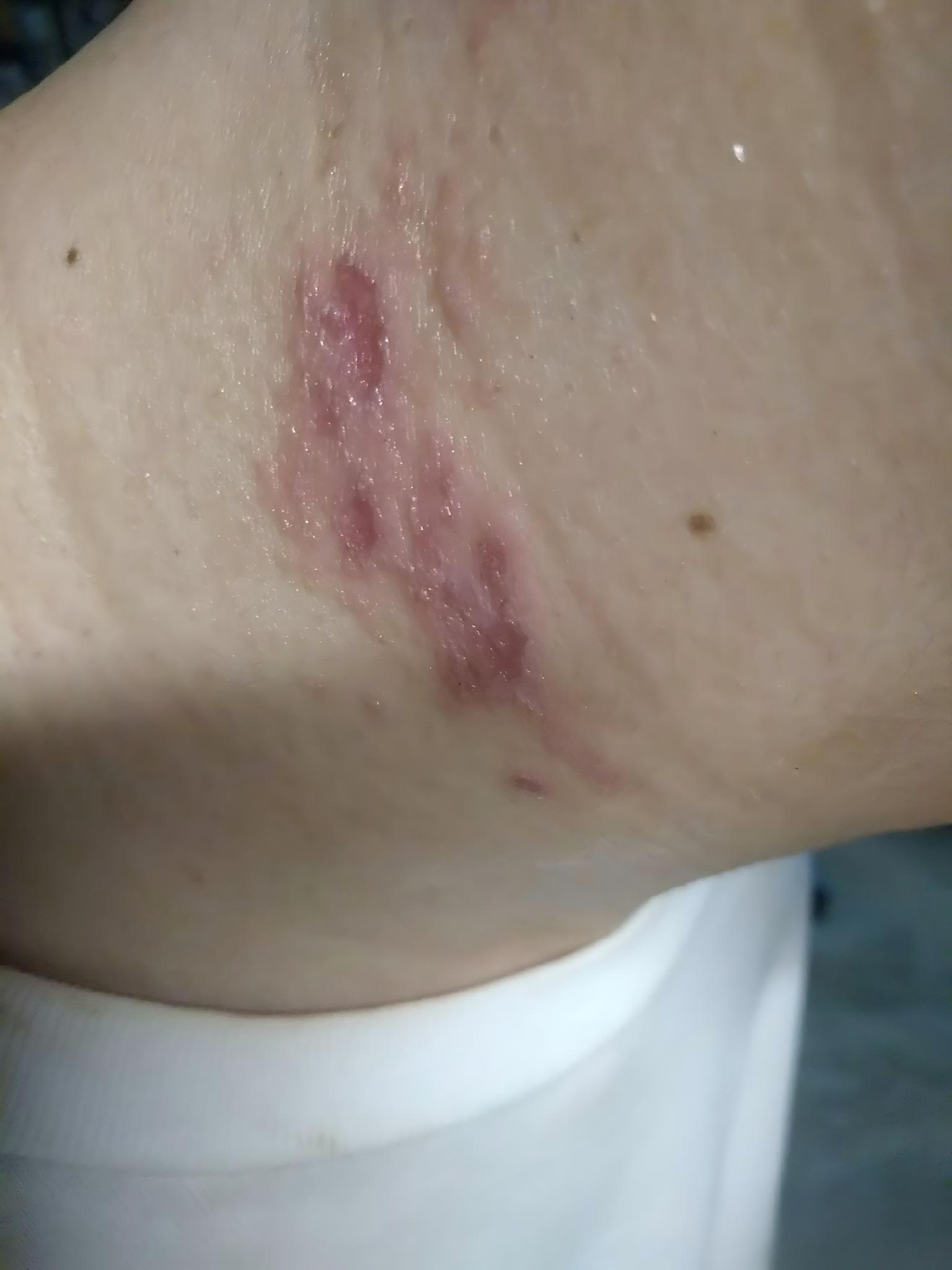 隐翅虫皮炎临床图谱