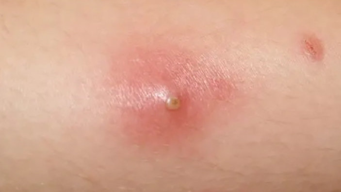 疖痈临床图谱