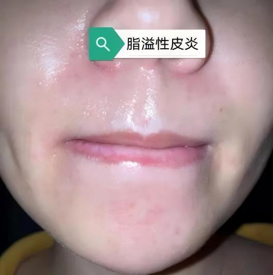 脂溢性皮炎临床图谱
