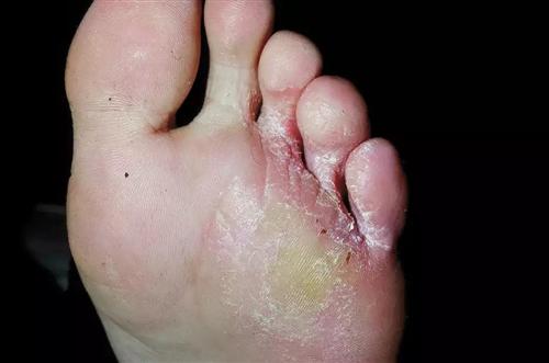足癣临床图谱